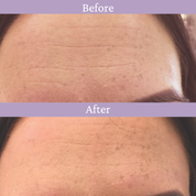 Ageless Lip & Line Filler