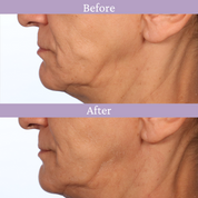 Ageless Jawline Uplift Serum