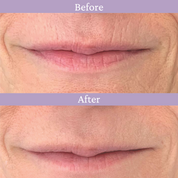 Ageless Lip & Line Filler