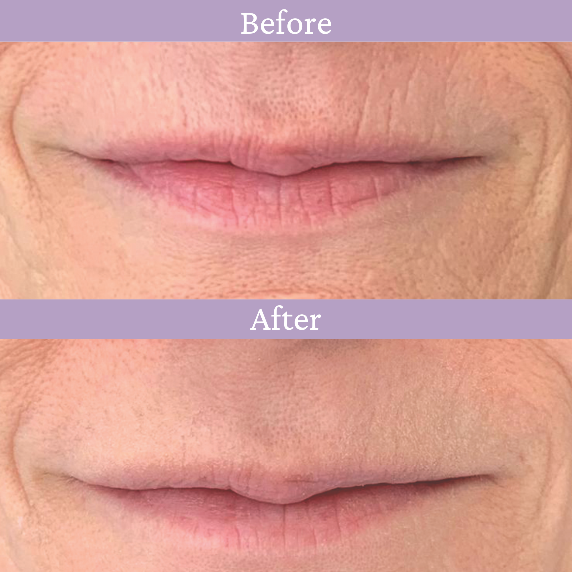 Ageless Lip & Line Filler